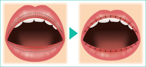口唇縮小術の手術方法
