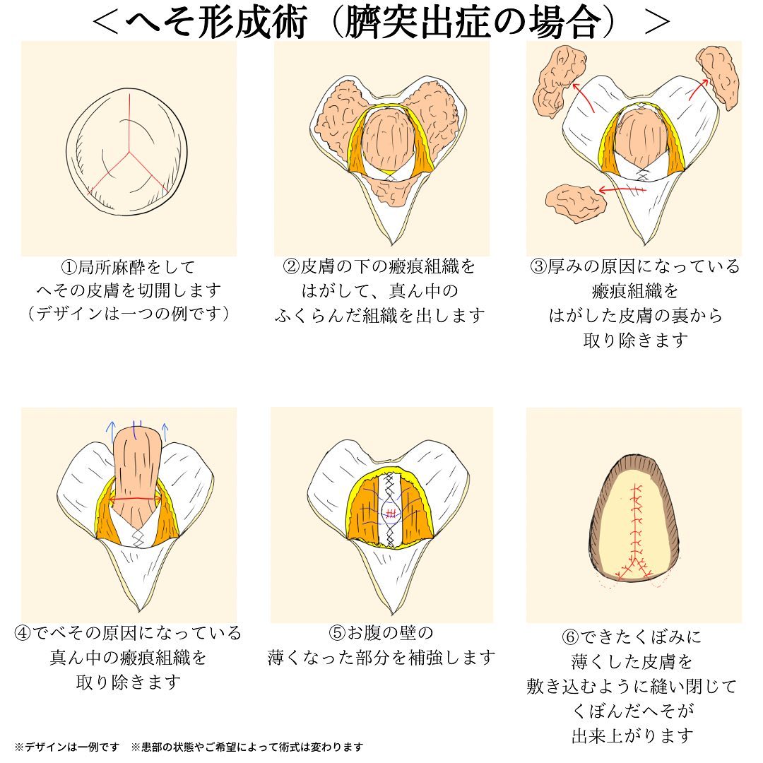 臍突出症の場合の治療法