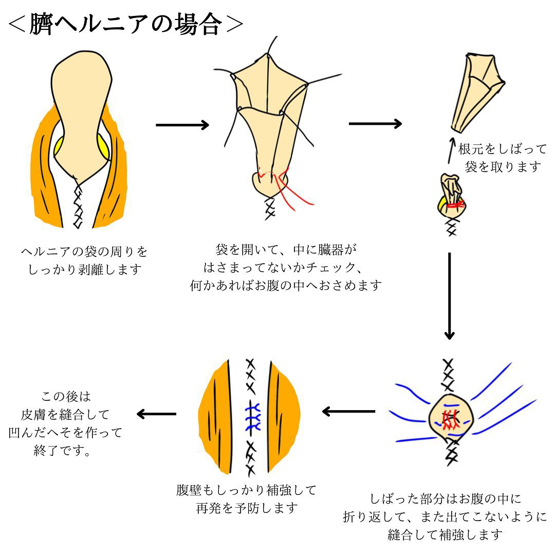 臍ヘルニアの場合の治療法