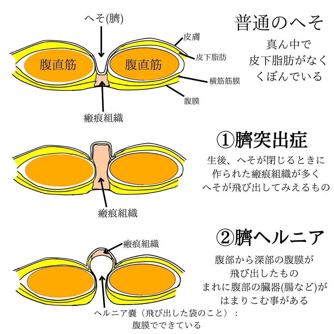 でべその種類