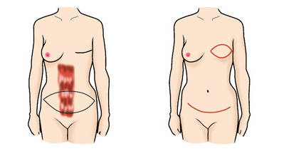 腹直筋皮弁を用いた方法