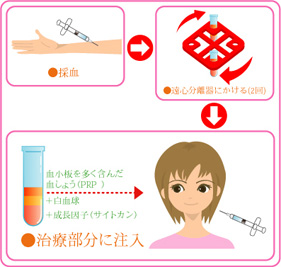 PRP療法の治療の流れ