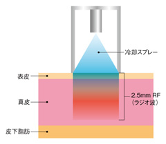 しわ・たるみはどうして起こるのか？