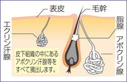 わきが・多汗症のすべて