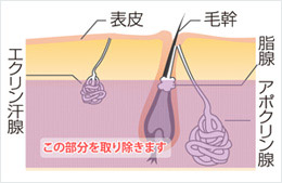 摘除箇所イメージ図