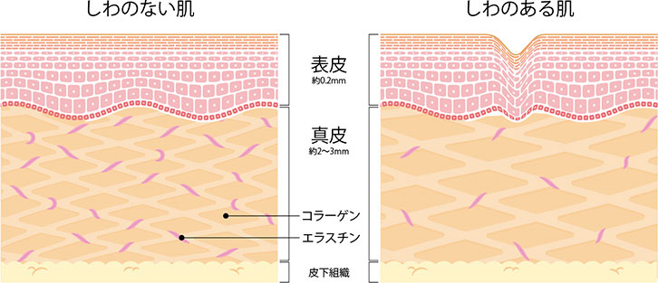 しわの原因