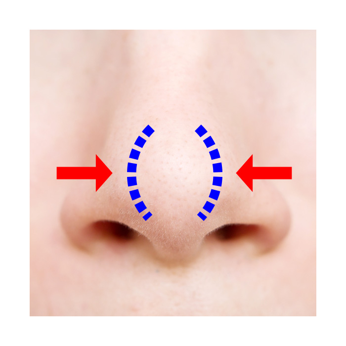 鼻尖縮小術（鼻尖形成術）