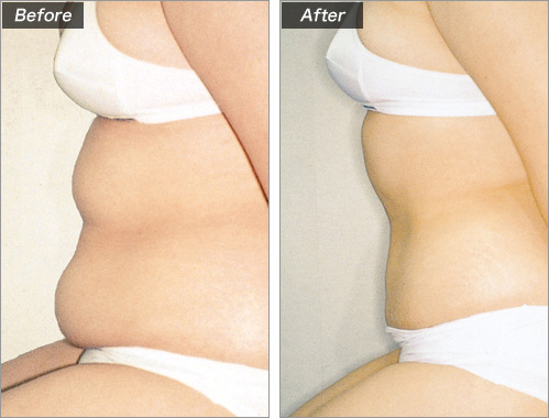 脂肪吸引（お腹） の症例写真
