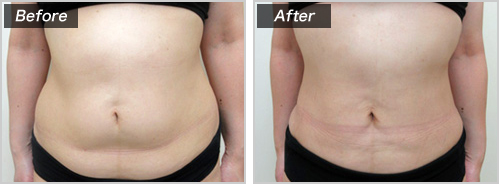 脂肪吸引・腹部＋背中の脂肪吸引の症例写真