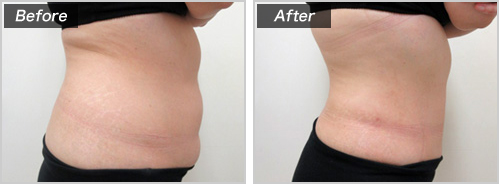 脂肪吸引・腹部＋背中の脂肪吸引の症例写真