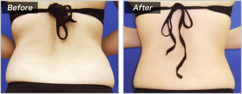 脂肪吸引（腰部＋腹部）の脂肪吸引の症例写真