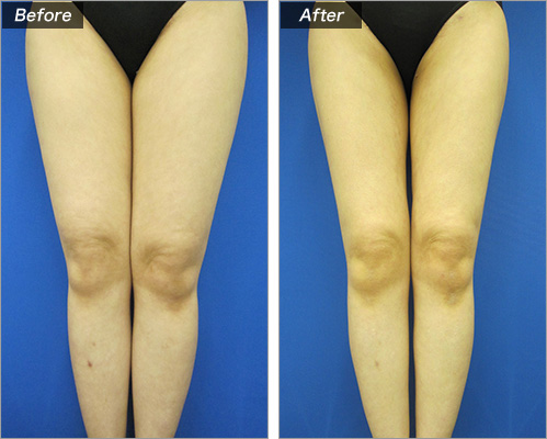 脂肪吸引・ひざ上下 の症例写真