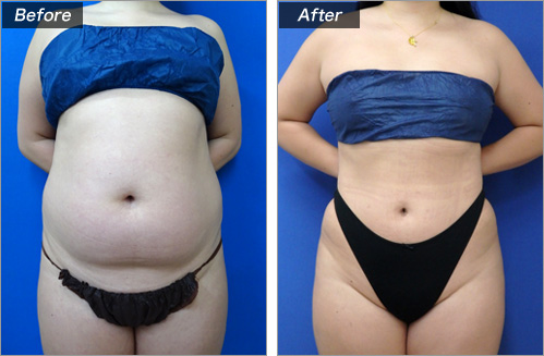 ピュアグラフト豊尻術＋脂肪吸引（腹部） の症例写真