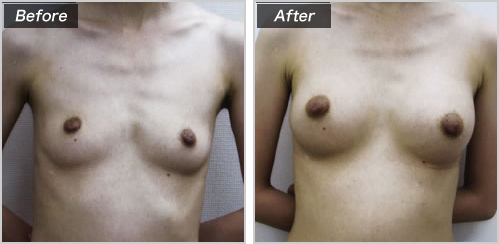 豊胸（人工乳腺法） の症例写真