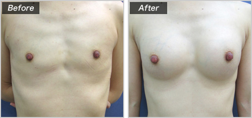 豊胸 人工乳腺の症例写真 Page 2 豊胸 豊胸手術なら城本クリニック