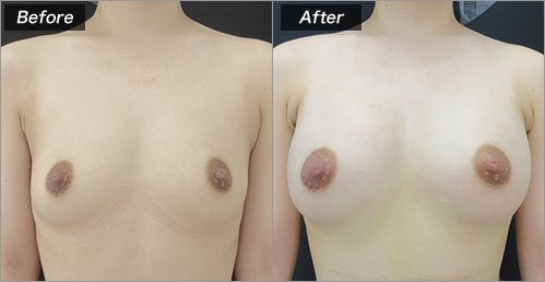 豊胸（人工乳腺法：230cc) の症例写真