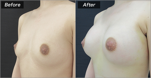 豊胸（人工乳腺法：230cc） の症例写真