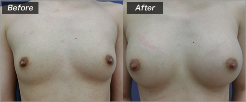 豊胸（人工乳腺法：170エルゴノミックスミニ) の症例写真