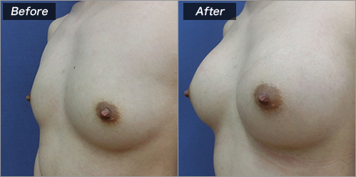 豊胸（人工乳腺法：170エルゴノミックスミニ) の症例写真