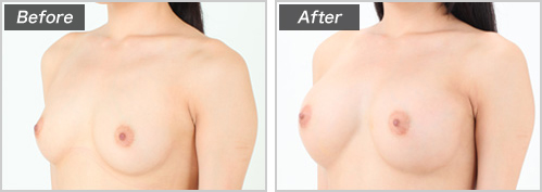 人工乳腺法（モデル・桜沢ゆりさん） の症例写真