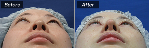 二重切開、眼瞼下垂、プロテーゼ挿入、鼻尖、耳介軟骨移植 の症例写真