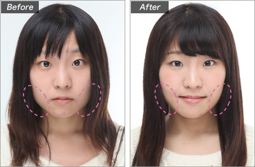 エラボトックス治療による小顔形成 の症例写真
