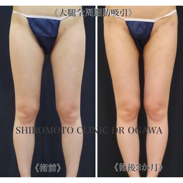 脂肪吸引（大腿全周、CRF脂肪豊胸のための吸引） の症例写真