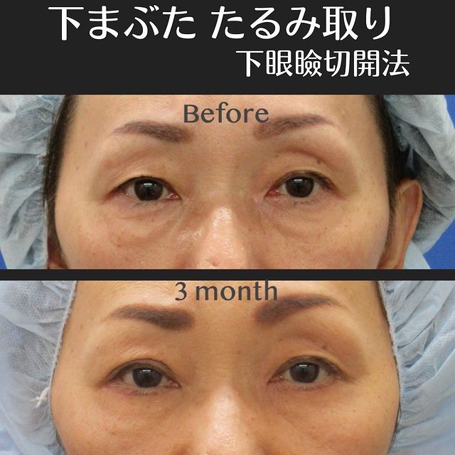 下眼瞼切開法(脂肪除去)、二重埋没法(4点留め)の症例写真