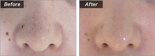 毛穴 レーザー の 鼻 鼻の毛穴の黒ずみは皮膚科でレーザー！５つの治療方法の違いは？