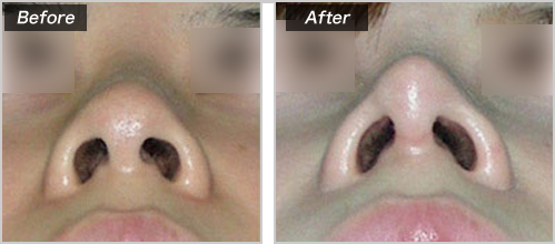 鼻尖形成術 の症例写真