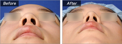 鼻尖縮小術（鼻尖形成術）・耳介軟骨移殖 の症例写真