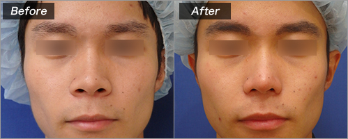 鼻尖縮小術・鼻尖形成術・耳介軟骨移殖・PDSシート、鼻翼縮小 の症例写真