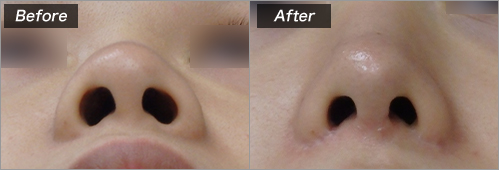 鼻尖形成L型フレーム　鼻翼縮小挙上 の症例写真