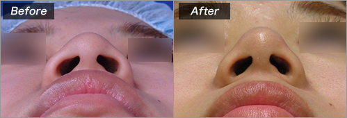 鼻尖縮小術　クローズ の症例写真