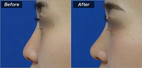 鼻尖縮小形成、片耳介軟骨L型フレーム移植 の症例写真