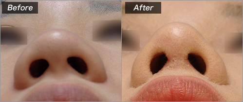 鼻尖形成L型フレーム　鼻翼縮小挙上 の症例写真