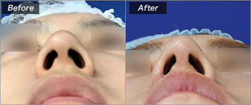 鼻尖縮小（L型フレームなし）鼻翼縮小挙上 の症例写真