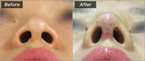 鼻中隔延長　両耳介軟骨移植 の症例写真