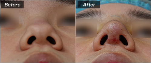 鼻中隔延長、I型プロテーゼ、両耳介軟骨移植 の症例写真