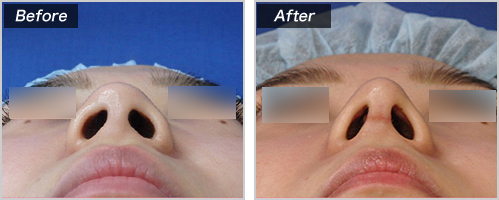 鼻中隔延长+耳介软骨移植的病例照片