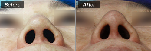 鼻中隔延長　他院プロテーゼ再加工 の症例写真