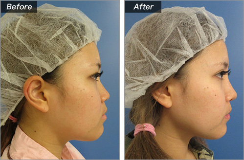 鼻プロテーゼ入れ＋耳介軟骨移植＋鼻尖形成 の症例写真