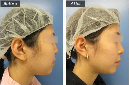 鼻骨切削+骨切块宽度+耳介软骨移植+鼻尖形成的病例照片