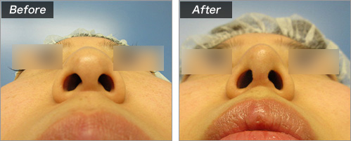 鼻骨切削+骨切块宽度+耳介软骨移植+鼻尖形成的病例照片
