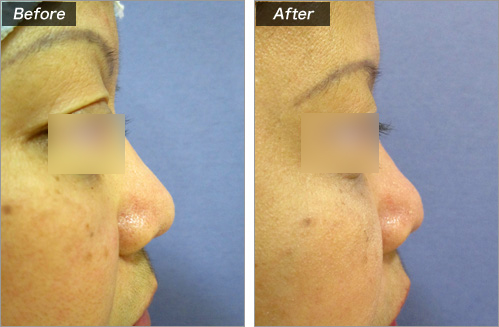 他クリニックの隆鼻プロテーゼの抜去 の症例写真