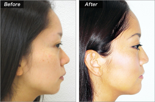 隆鼻術・顎プロテーゼ挿入（OL・吉川エリさん） の症例写真
