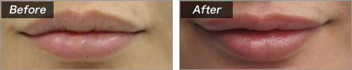 ヒアルロン酸注入（唇） の症例写真