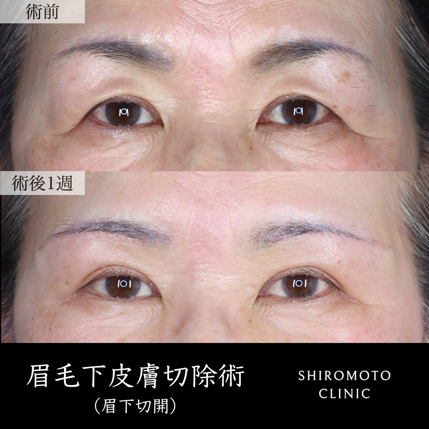 眉下切開