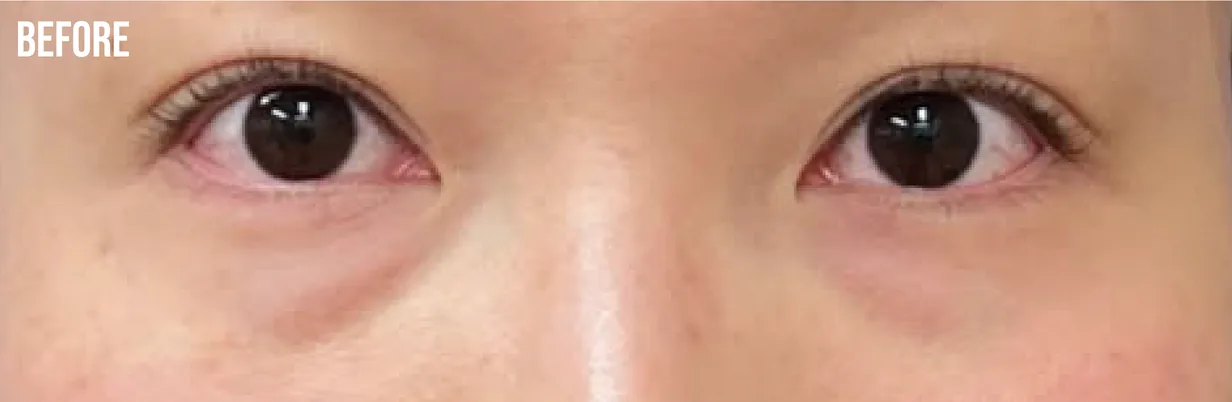 症例写真（BEFORE）