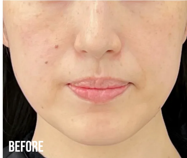 症例写真（BEFORE）